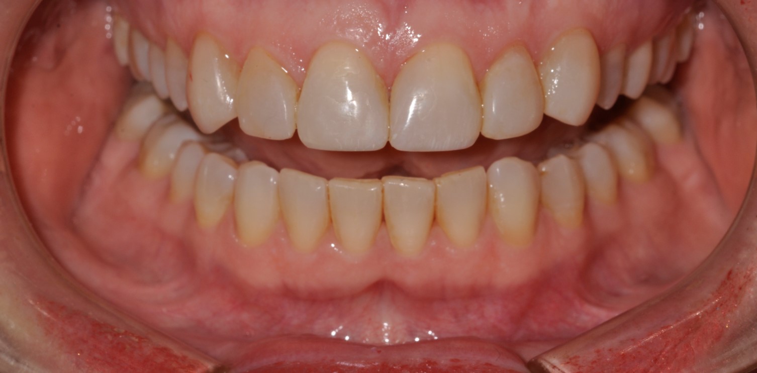 Cosmetic Bonding Halifax, NS Dr. Jenine Arab Omalley